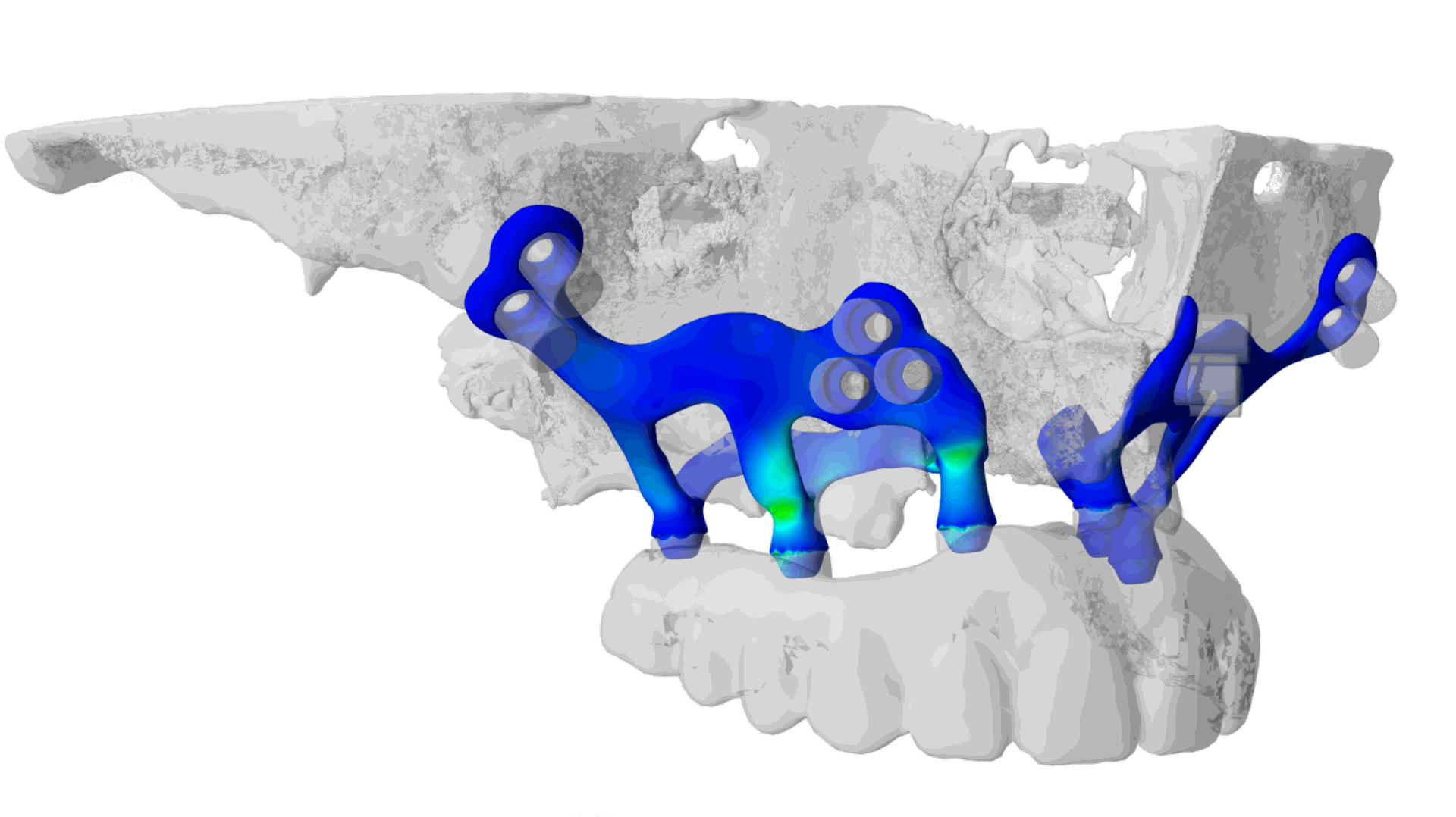 Custommade subperiosteal dental implant